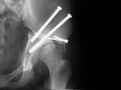 name this osteotomy that is used in salvage situations.  Inadequate femoral head coverage and a concentric reduction cannot be obtained
Described the technique to perform
order for this to be successful what most of occur and why is used