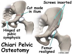 Chiari osteotomy
Make cut above the sciatic notch and shift the ilium lateral beyond the edge of the acetabulum
depends on fibrocartilage metaplasia for successful result and also medialize his acetabulum for a concentric reduction via the iliac ...