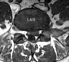  A 32-year-old male presents with left leg pain and weakness. An axial image from his MRI is shown in Figure A. Which of the following physical exam findings would be most consistent with this MRI finding.


1.  Numbness over dorsal aspect of...