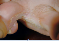 What causes this Dermatophytosis: Tinea pedis