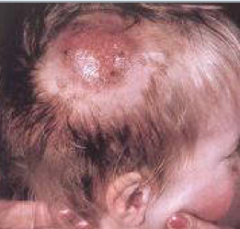 What causes this Dermatophytosis: Tinea capitis