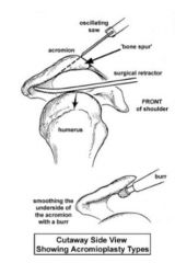 - Anterior inferior surface of acromion is reduced and smoothed to reduce rotator cuff impingement 
- When acromion has bone spur or is hooked (causing shoulder impingement) 
- No
- Pain is severe due to bone healing