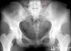 what are the radiographic signs of instability