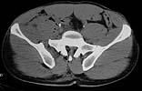 anterior posterior compression3
Hemorrhage injury to the superior gluteal artery
Anterior symphyseal multihole plate or ex-fix with posterior stability stabilization with SI screws and plate and screws