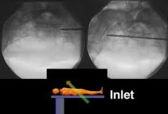 when placing iliosacral screw screws percutaneously into the safe zone of the S1 vertebral body what radiographic view is past for superior inferior screw placement
Which review is best for anterior posterior screw placement