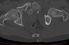 what is the indication for a diverting colostomy
what is the most common neurologic injury in the pelvic ring
what is the diagnosis of this image & what is does it mean?
what kind of CATHETER IS CONTRAINDICATED WITH ANTERIOR RING PLATING