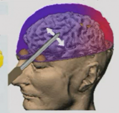 Calming effect, decrease aggressiveness.
Lobectomies of this area in schizophrenia patients resulted in patients becoming docile and institutionalized.
Frontal lobotomy - cut connections between orbitofrontal cortex and rest of brain. Go through e...