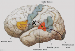 Damage to arcuate fasciculus
Able to comprehend spoken or written language (Wernicke's area is intact)
Because Wernicke's cannot control Broca's, speaks in word salad.