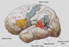 Lesion in angular gyrus
Affects reading while sparing other components of language.