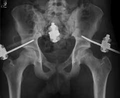  What nerve is most at risk when applying the external fixator shown in Figure A using a minimally invasive fluoroscopic technique of pin insertion?


1.  Ilioinguinal nerve


2.  Obturator nerve


3.  First branch of the femoral nerv...