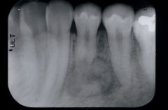 Broad class of lesions that form cementum (bone-like CT that covers tooth root). 
Tumors usually arise at the tip of tooth roots in oung adults. 
The radiographic appearance can vary from radiolucent to densely radiopaque, depending on the lesio...