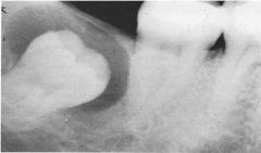 Dentigerous (follicular) cyst - is a development abnormality caused by a defect in enamel formation.
It is ALWAYS associated with an unerupted tooth crown, and most common in the mandibular third molar or maxillary cuspid. 
Ameloblastoma formati...