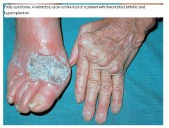 what is the diagnosis rheumatoid arthritis splenomegaly and leukopenia