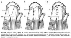 what the classification of this shape cuff tear
What of the other classification that described shape cuff tear

 