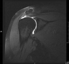 A 55-year-old carpenter presents with 6 weeks of right shoulder pain after installing ceiling drywall. He has no symptoms of night pain. His examination reveals 30 degrees lack of full flexion and abduction. He has full strength of the right shoul...