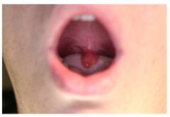 Quincke's disease 
- swelling of the uvula often in association with acute bacterial tonsillitis. 
- uvular swelling can also occur with trauma (heroin snorting, burn from hot food or beverages)