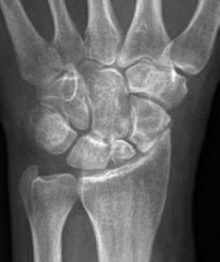 most common complication with nonunion scaphoid
treatment of this complication
degenerative changes occur I what joints,wears a seen 1st