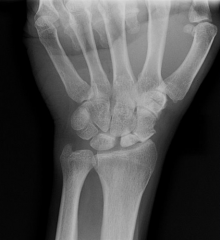 A 30-year-old female reports 5 months of wrist pain after a fall onto her wrist. A radiograph is shown in Figure A. If untreated, all of the following degenerative changes may be observed EXCEPT?


1.  radial styloid osteophyte


2.  radio...