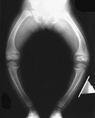 patient presents with this x-ray what is the diagnosis
Wears the pathology, what laboratory values are abnormal – phosphorus, alkaline phosphatase, calcium
what is the treatment