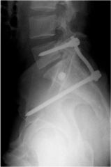  what is the most stable construct for fixation for an unstable transforaminal sacral fracture