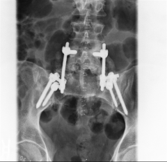 Combined iliosacral and lumbopelvic fixation (triangular osteosynthesis) for sacral fractures has the greatest stiffness when used for an unstable sacral fracture. 



The referenced article by Schildhauer et al is a cadaveric study that examin...