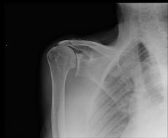 patient presents with pseudoparalysis of the shoulder pain subjective weakness


what is the diagnosis
With the Best study to confirm the diagnosis
what is the treatment-the young adult versus old
