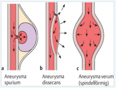 - Aneurysma verum (echtes Aneurysma) (80%)


- Aneurysma dissecans (15-20%)


- Aneurysma spurium (falsches Aneurysma)