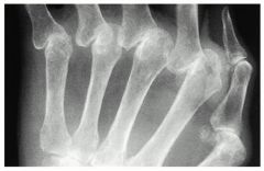  A 64-year-old female with rheumatoid arthritis has decreased functional use of the left hand for activities of daily living. On physical examination she has fixed deformities of the metacarpophalangeal (MCP) joints as demonstrated in Figure A. A...