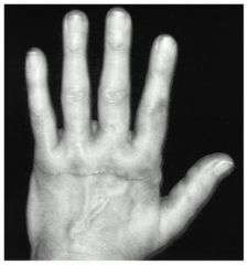 The history, clinical image, and radiograph demonstrate severe MCP joint involvement with fixed deformities. MCP arthroplasty is the procedure of choice for severe finger MCP joint arthritis involvement or fixed deformities. Thumb MCP involvement ...