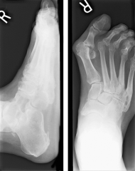  A 43-year-old female with long-standing rheumatoid arthritis complains of right forefoot pain for several years. She has failed conservative treatment and radiographs are shown in Figure A. What is the most appropriate treatment?


1.  Bunio...