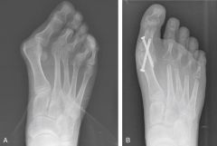 Surgical treatment of a rheumatoid forefoot involves fusion of the 1st MTP and lesser metatarsal head resections. The earliest manifestation of rheumatoid arthritis of the forefoot is synovitis of the MTP joints with eventual hyperextension deform...