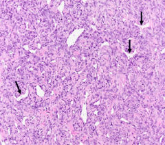 Discuss Hemangiopericytoma


* Staghorn-shaped capillary spaces lined by plump pericytes (arrows)