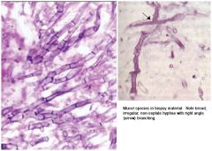 A: Mucor – Broad & ribbonlike (10-15 um), irregular/90 degree branching, rarely septated; order Mucorales in Zygomycetes class, most virulent and common is Rhizopus oryzae; more commonly seen in diabetic ketoacidotic patientsA: Aspergillus – N...