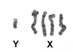 A common disorder that occurs when a person has three copies of chromosome 47, XXY.
