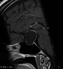 50YO male with bitemporal hemianopsia, MRI shows the above lesion. 
Identify. When does it usually present? Gender ratio? What is a tumor of this location called? 
