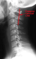 Connects
the points bisecting the bases of the spinous processes of C1 and C3 Pseudosubluxation
allowed in children at C2/C3 ≤ 2 mm
Predental
space: 3mm in adults, 5 mm in children   
