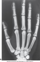 Rare hereditary bone dysplasia in which failure of the resporptive mechanism of calcified interferes with the normal replacement by mature bone 
 
Results in extremely dense bones 
 
Often Fatal