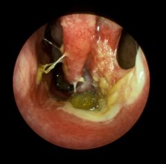 12YO female with chronic nasal obstruction and anosmia. On physical exam her nose has a foul smell with yellow crusting, and she has a 6mm septal perforation. She also has a right middle ear effusion.
 
Identify this condition. Pathophys? Name so...