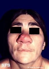 47YOF Honduran  with history of purulent rhinorrhea and dysphonia with sclerosis/fibrosis of the nose on examination.
 
Identify. In what regions is this disease endemic? What are the three stages of disease and their respective s/sx? What are...