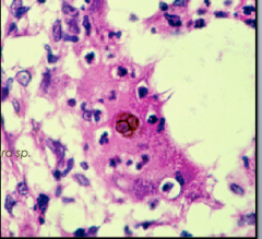 










•Sclerotic bodies – black dots - in biopsied tissue