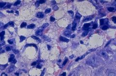 What type of cells are these? What disease are they associated with?