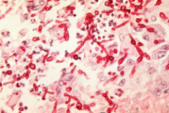 Phaeohyphomycosis characterized by yeast-like cells or hyphae seen
in the tissue.

What is this?