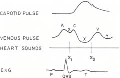 The "a" wave follows the P wave of the EKG and peaks just before the 1st heart sound