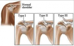 Type 1 - Small Fray
Type 2 - Clean Cut
Type 3- Tear of Coracoid clavicular
 
Mumford Procedure - although a lot are not repaired