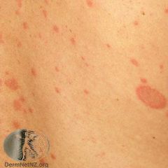 A young adult presents with a rash that started with 1 oval lesion, and 1 week later had many smaller oval salmon patches over their chest and back. What is this condition?