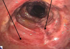 - Distribution is segmental and patchy
- Mucosa is hemorrhagic and often ulcerated