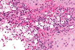 3rd world chronic granulomatous bacterial disease of the nose 

Dx? 
cause?
name for the foamy histiocytes?