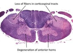 loss of motor neurons in the ANTERIOR HORN cells and lateral / corticospinal tracts