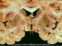 Atrophy of mamillary bodies, hypothalamus, anterior thalamic nucleus