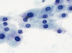 Apocrine metaplasia

Large, flat sheets of apocrine cells have distinct cytoplasmic borders, a centrally located nucleus,
and a prominent nucleolus. Abundant granular cytoplasm is gray-purple